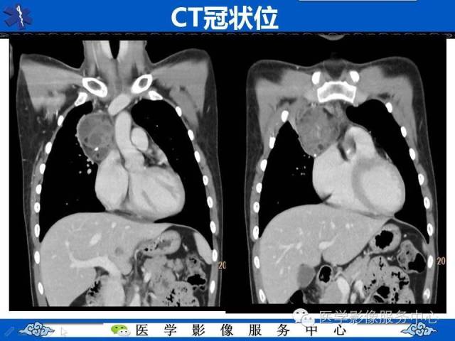 【病例】纵隔混合性生殖细胞瘤1例CT影像表现