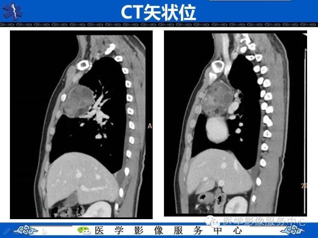 【病例】纵隔混合性生殖细胞瘤1例CT影像表现