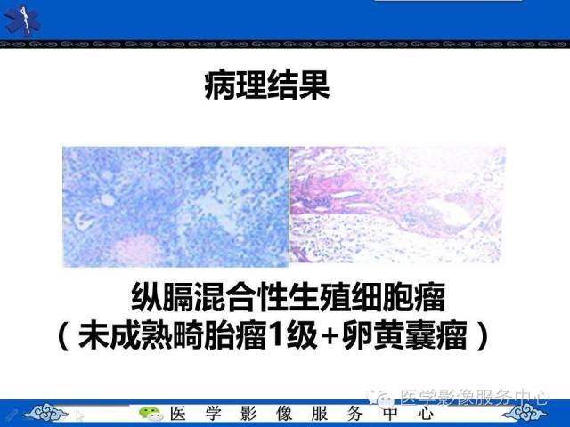 【病例】纵隔混合性生殖细胞瘤1例CT影像表现