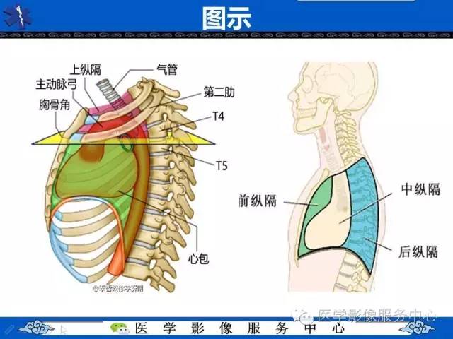 【病例】纵隔混合性生殖细胞瘤1例CT影像表现