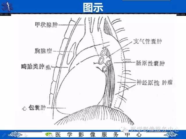 【病例】纵隔混合性生殖细胞瘤1例CT影像表现