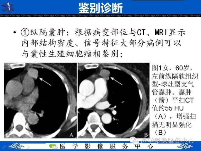 【病例】纵隔混合性生殖细胞瘤1例CT影像表现