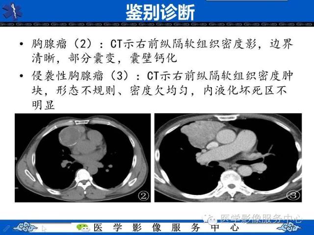【病例】纵隔混合性生殖细胞瘤1例CT影像表现