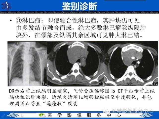 【病例】纵隔混合性生殖细胞瘤1例CT影像表现