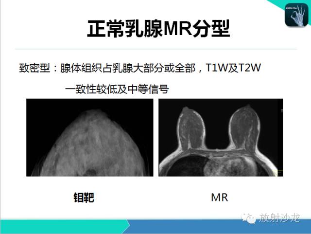 【PPT】乳腺病变的MR诊断