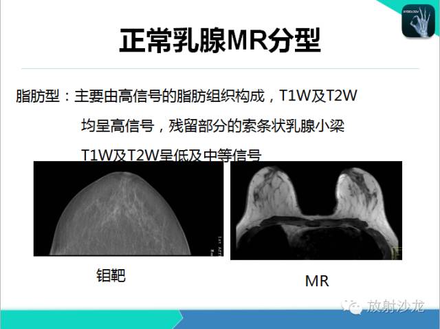 【PPT】乳腺病变的MR诊断