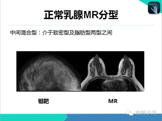 【PPT】乳腺病变的MR诊断
