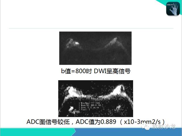 【PPT】乳腺病变的MR诊断