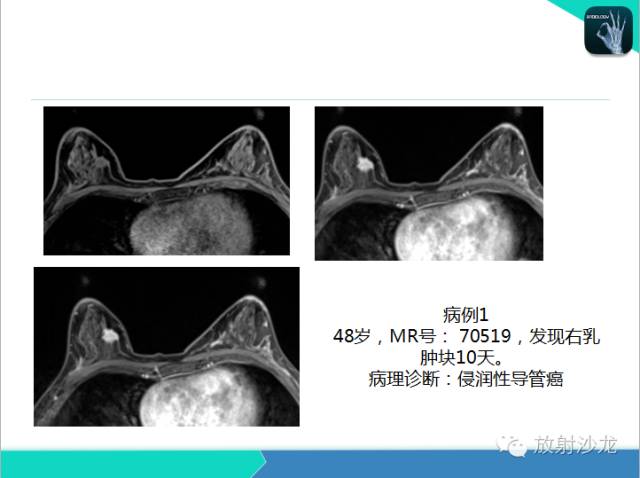 【PPT】乳腺病变的MR诊断