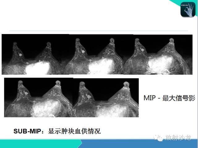 【PPT】乳腺病变的MR诊断