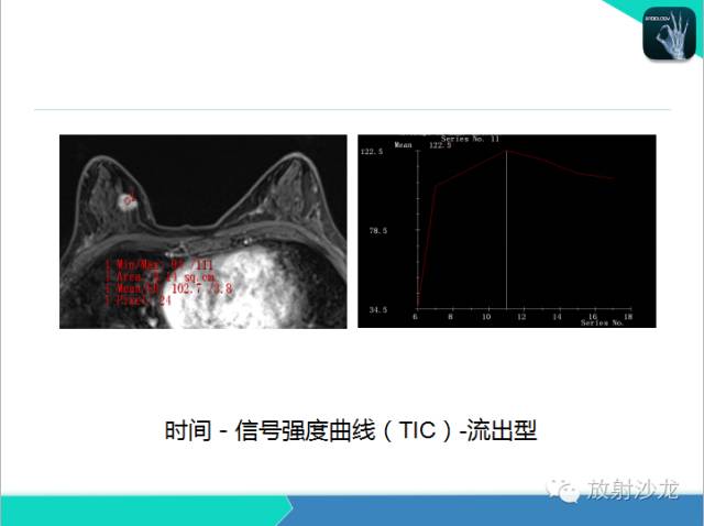 【PPT】乳腺病变的MR诊断