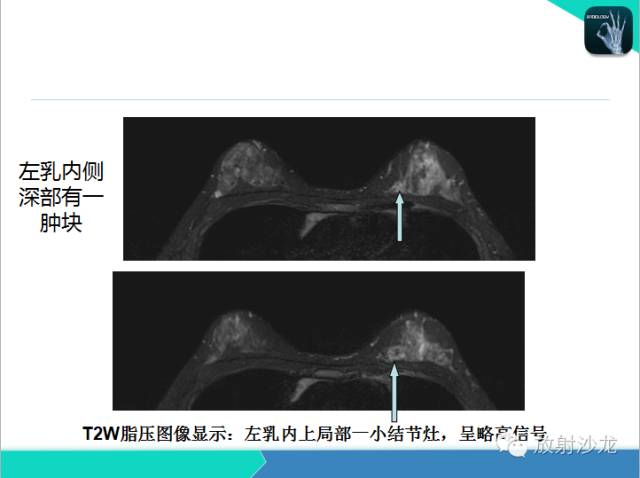【PPT】乳腺病变的MR诊断
