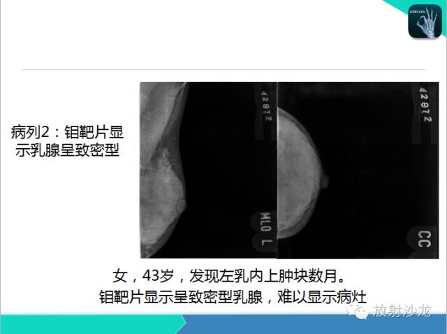 【PPT】乳腺病变的MR诊断