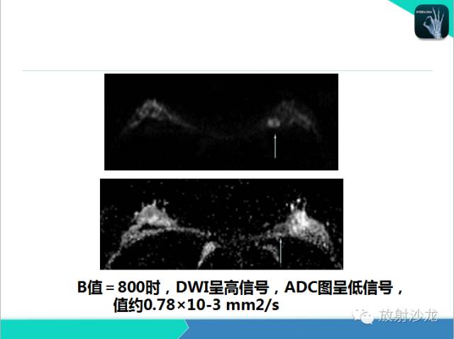【PPT】乳腺病变的MR诊断