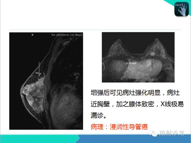 【PPT】乳腺病变的MR诊断
