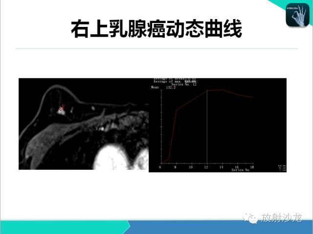 【PPT】乳腺病变的MR诊断