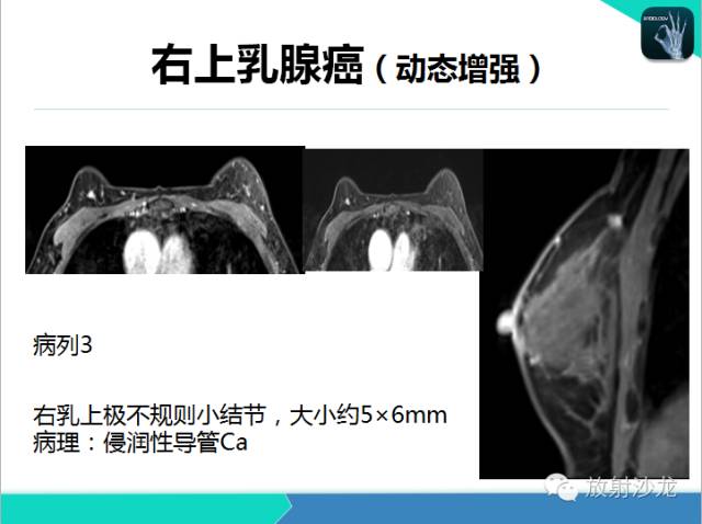 【PPT】乳腺病变的MR诊断