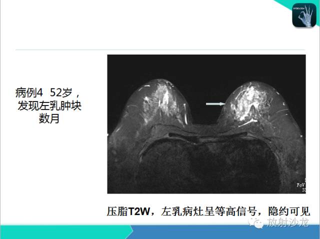 【PPT】乳腺病变的MR诊断