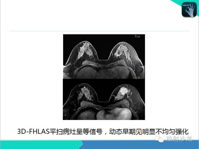 【PPT】乳腺病变的MR诊断