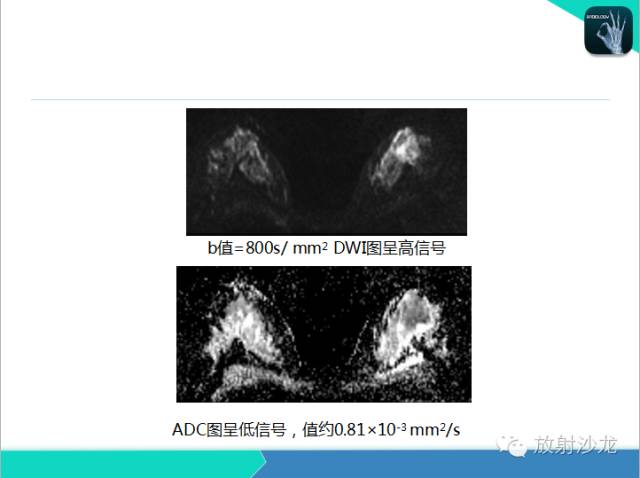 【PPT】乳腺病变的MR诊断