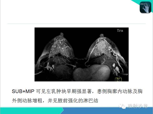 【PPT】乳腺病变的MR诊断