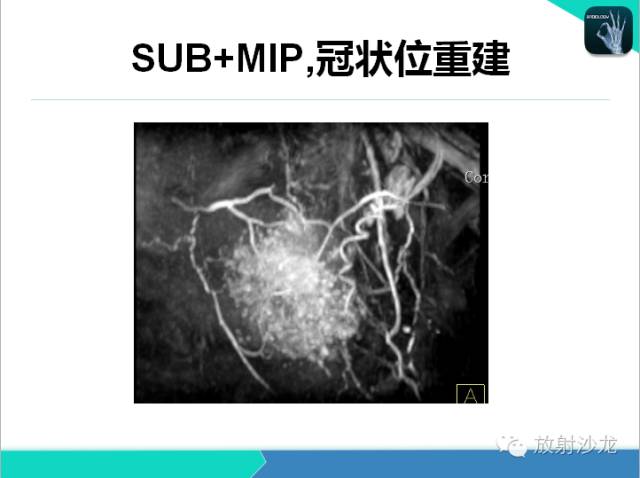 【PPT】乳腺病变的MR诊断
