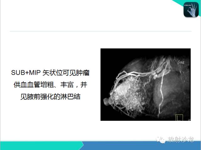 【PPT】乳腺病变的MR诊断