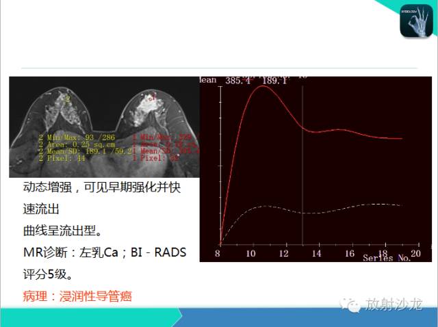 【PPT】乳腺病变的MR诊断