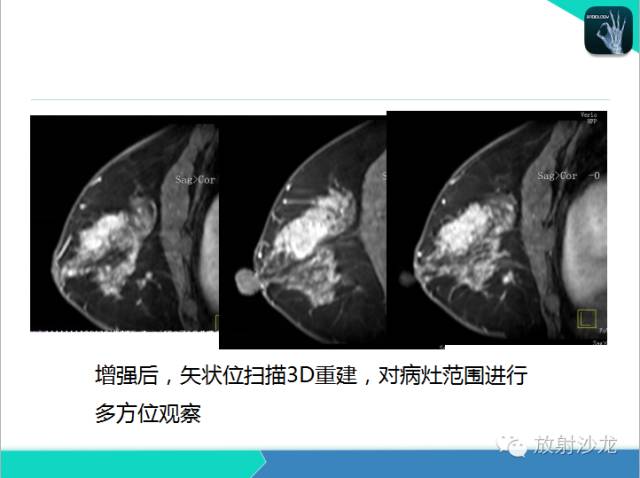 【PPT】乳腺病变的MR诊断