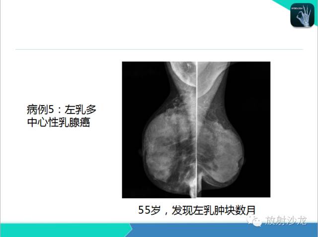 【PPT】乳腺病变的MR诊断