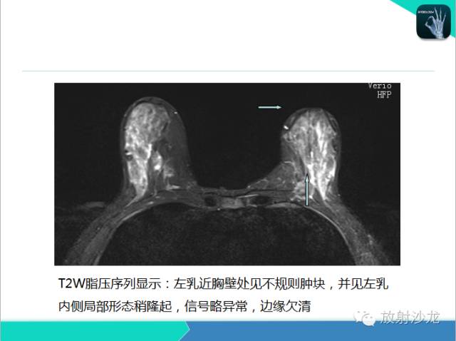 【PPT】乳腺病变的MR诊断