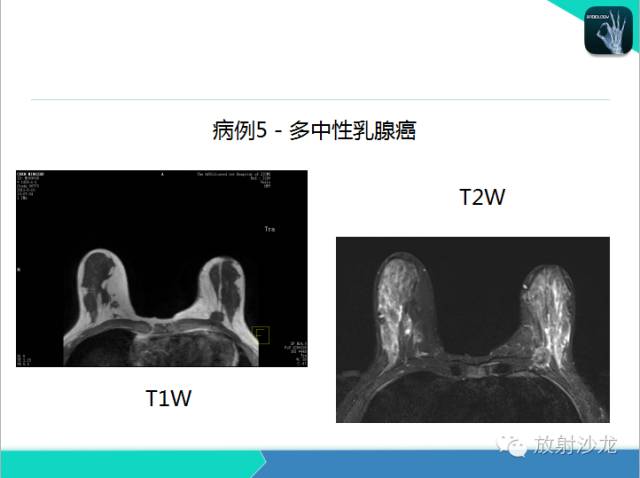 【PPT】乳腺病变的MR诊断