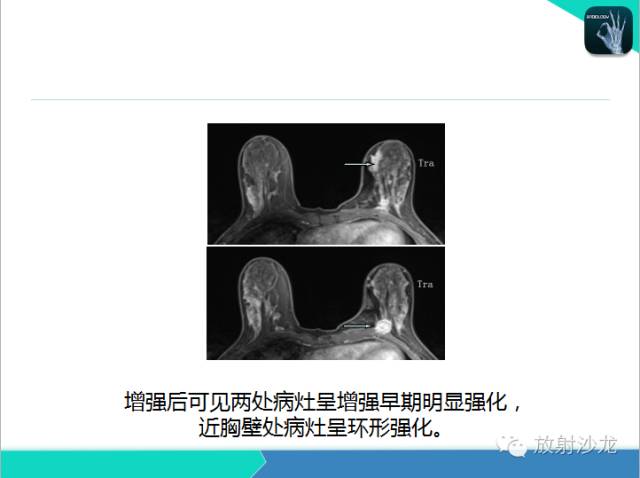 【PPT】乳腺病变的MR诊断