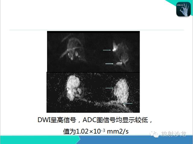 【PPT】乳腺病变的MR诊断