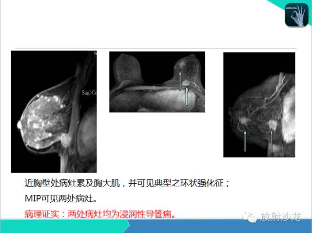 【PPT】乳腺病变的MR诊断