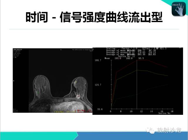【PPT】乳腺病变的MR诊断