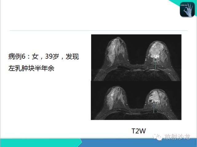 【PPT】乳腺病变的MR诊断