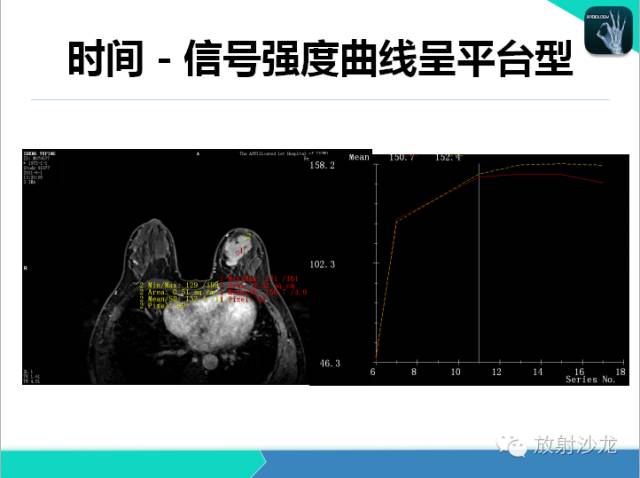 【PPT】乳腺病变的MR诊断