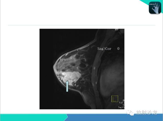 【PPT】乳腺病变的MR诊断