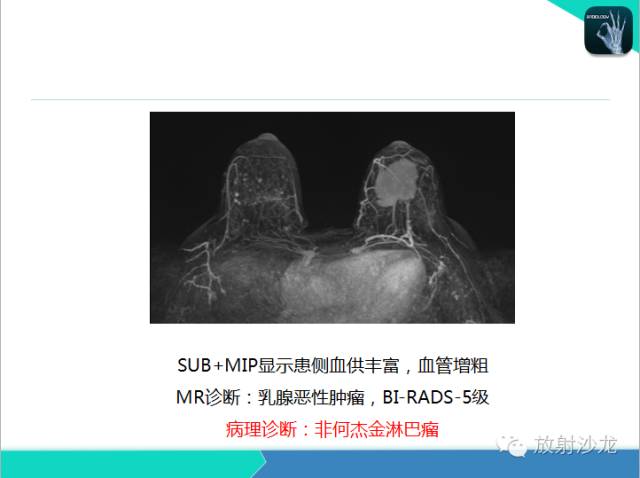 【PPT】乳腺病变的MR诊断