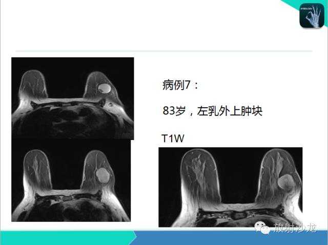 【PPT】乳腺病变的MR诊断