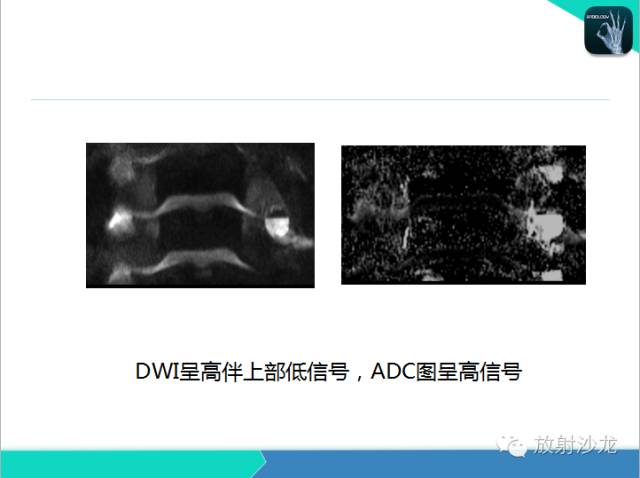 【PPT】乳腺病变的MR诊断