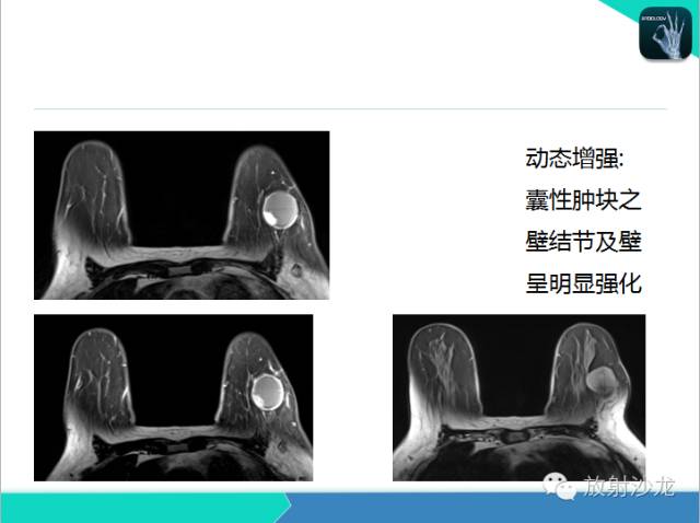 【PPT】乳腺病变的MR诊断