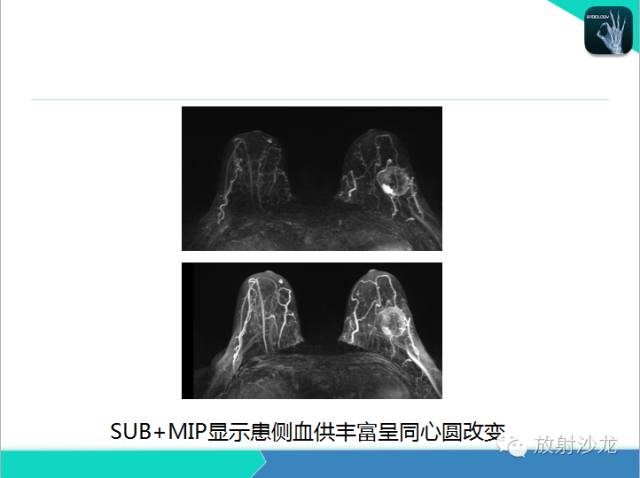 【PPT】乳腺病变的MR诊断