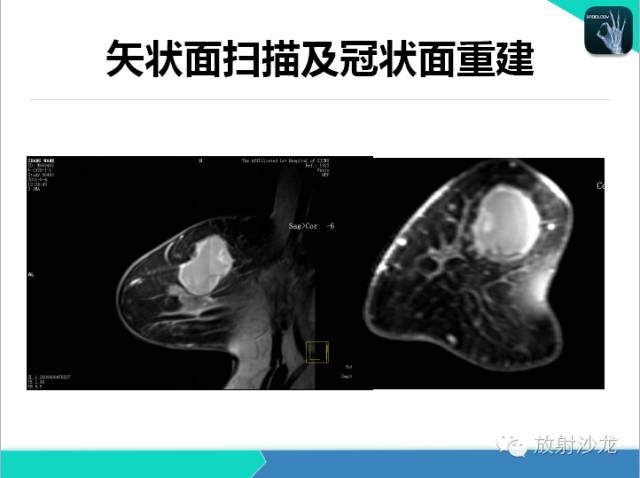 【PPT】乳腺病变的MR诊断