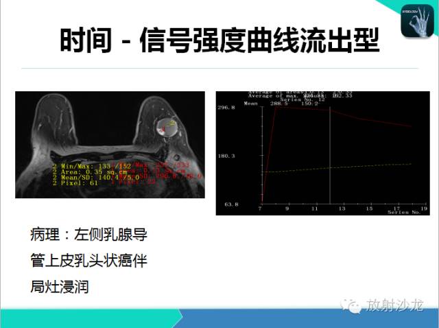 【PPT】乳腺病变的MR诊断