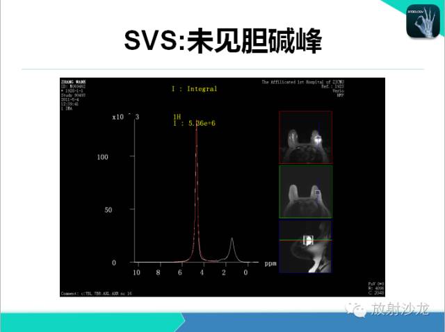 【PPT】乳腺病变的MR诊断