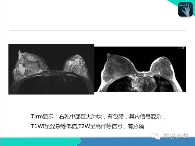 【PPT】乳腺病变的MR诊断