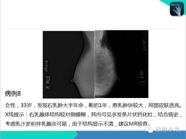 【PPT】乳腺病变的MR诊断