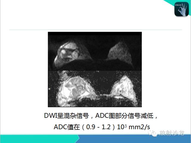 【PPT】乳腺病变的MR诊断